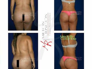 Antes y despues de liposuccion