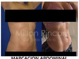 Antes y despues de marcacion abdominal