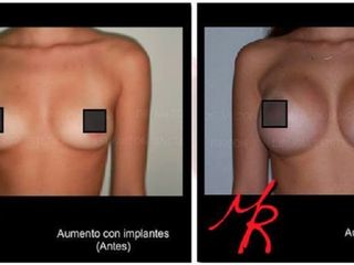 Antes y despues de aumento de senos