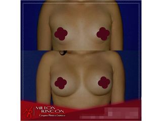 Mamoplastia de aumento 