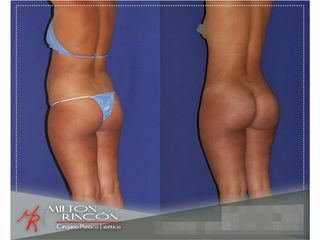 Gluteoplastia