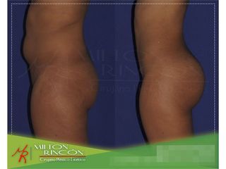 Gluteoplastia