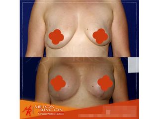 Mamoplastia de aumento 