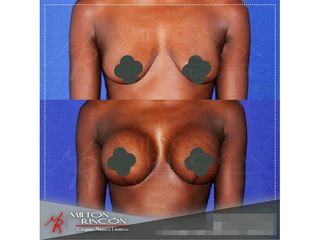 Mamoplastia de aumento 