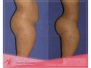 Gluteoplastia