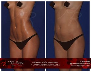 Lipo marcación abdominal