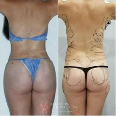 Liposucción - Dr. Milton Rincón Carranza