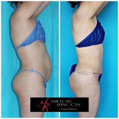 Abdominoplastia - Dr. Milton Rincón Carranza