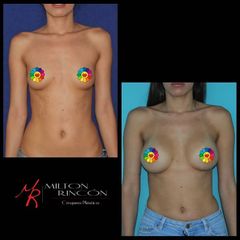 Mamoplastia de aumento 