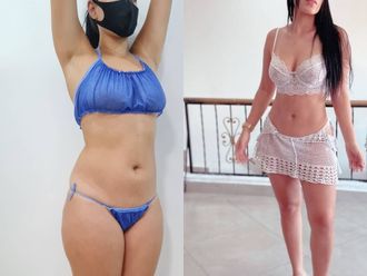 Liposucción antes y después - 789597