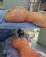 Gluteoplastia - Dr. Milton Rincón Carranza