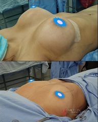 Mamoplastia de aumento - Dr. Milton Rincón Carranza