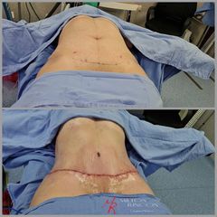 Abdominoplastia - Dr. Milton Rincón Carranza