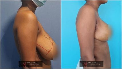 Mamoplastia de reducción - Dr. Milton Rincón Carranza