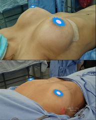 Mamoplastia de aumento - Dr. Milton Rincón Carranza