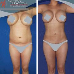 Liposucción - Dr. Milton Rincón Carranza