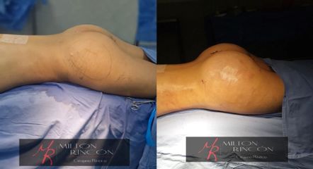 Gluteoplastia - Dr. Milton Rincón Carranza