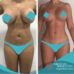 Liposucción - Dr. Milton Rincón Carranza