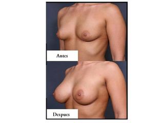 Mamoplastia
