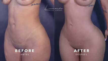Lipoescultura Secundaria -Dr. Leonardo Carrillo