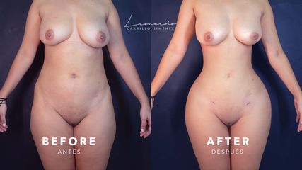 Lipoescultura Primaria -Dr. Leonardo Carrillo