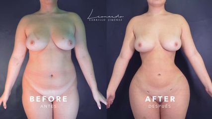 Lipoescultura Primaria -Dr. Leonardo Carrillo