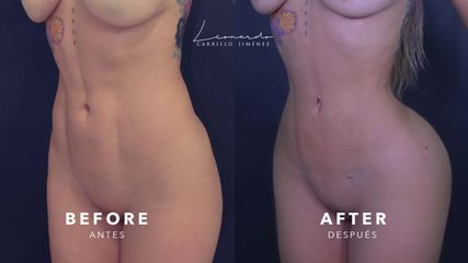 Lipoescultura Secundaria (reparación fibrosis) -Dr. Leonardo Carrillo