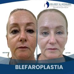 Blefaroplastia - Dra. Deisy M. Mosquera