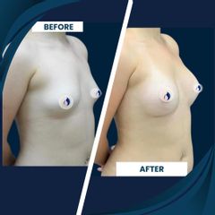 Mamoplastia de aumento - Dra. Deisy M. Mosquera
