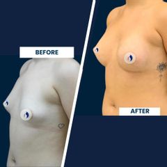 Mamoplastia de aumento - Dra. Deisy M. Mosquera