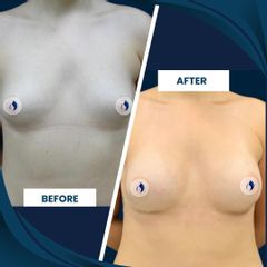 Mamoplastia de aumento - Dra. Deisy M. Mosquera