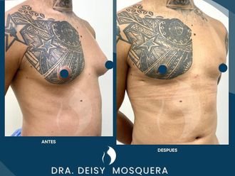 Ginecomastia antes y después - 861406