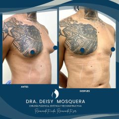 Ginecomastia - Dra. Deisy M. Mosquera