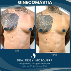Ginecomastia - Dra. Deisy M. Mosquera
