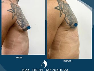 Ginecomastia antes y después - 861408