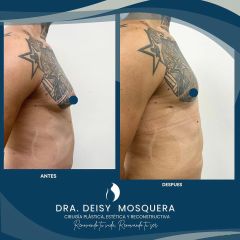 Ginecomastia - Dra. Deisy M. Mosquera