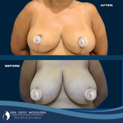 Mamoplastia de reducción - Dra. Deisy M. Mosquera