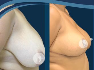 Mamoplastia de reducción antes y después - 861410