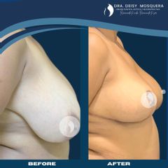 Mamoplastia de reducción - Dra. Deisy M. Mosquera