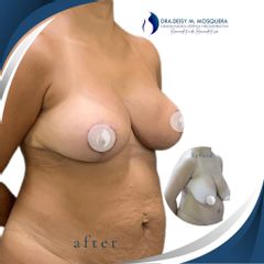 Mamoplastia de reducción - Dra. Deisy M. Mosquera