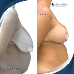 Mamoplastia de reducción - Dra. Deisy M. Mosquera