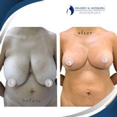 Mamoplastia de reducción - Dra. Deisy M. Mosquera