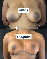 Mastopexia sin implantes - Dra. Deisy M. Mosquera