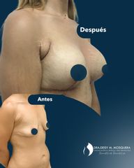 Cirugia Post Bariátrica - Dra. Deisy M. Mosquera