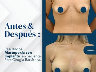 Levantamiento de senos antes y después - 873457