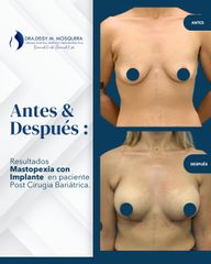 Mastopexia con implantes - Dra. Deisy M. Mosquera