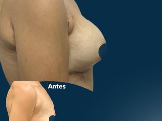 Mamoplastia de aumento antes y después - 873461