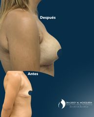 Cirugia Post Bariatrica -Dra. Deisy M. Mosquera