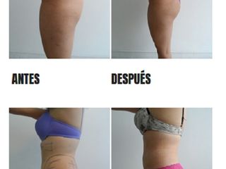 Gluteoplastia