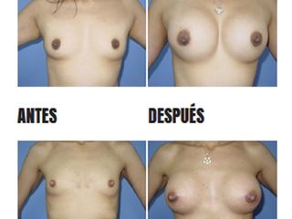 Mamoplastia